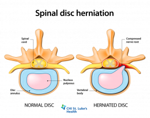 How a Houston chiropractor help treat herniated disc